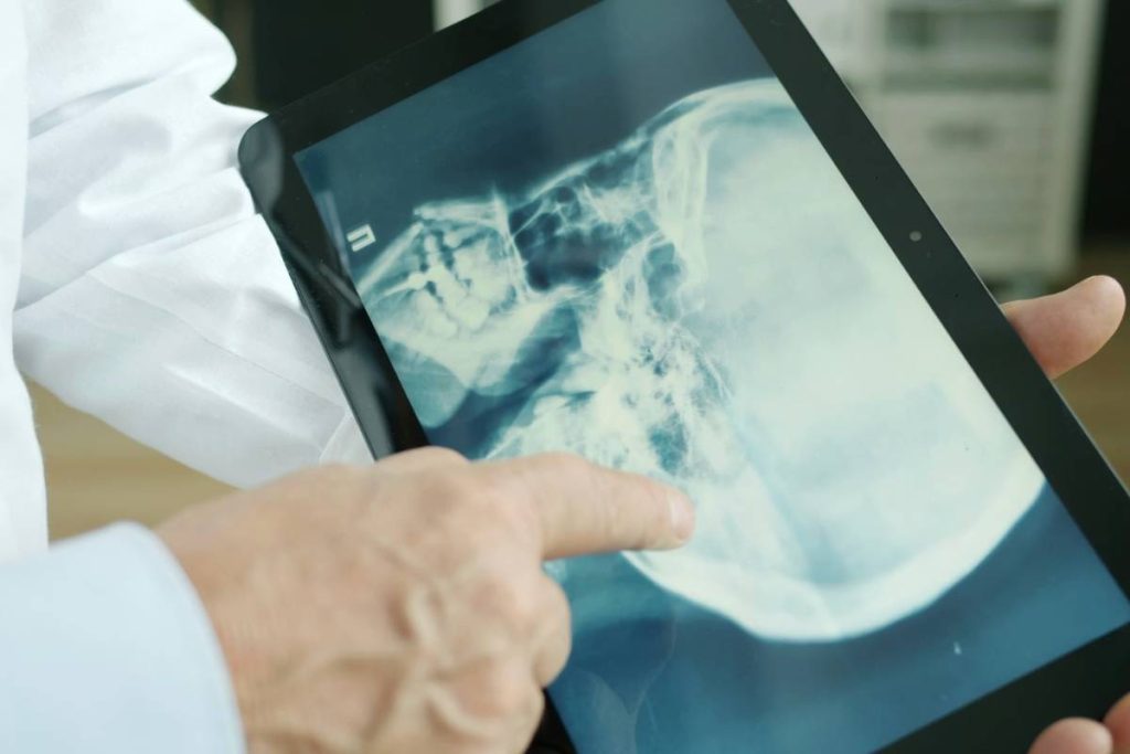 does-medicaid-cover-tms-therapy