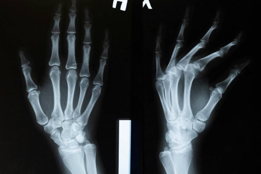 does-medicare-cover-bone-density-test