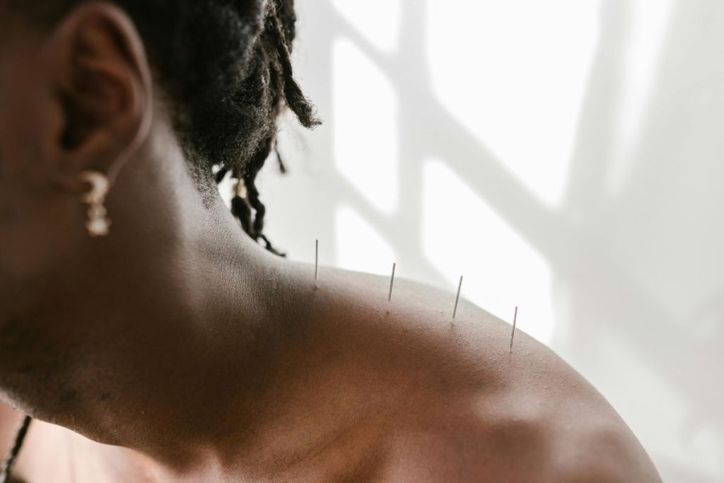 does medicare pay for acupuncture